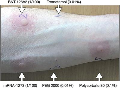 Intradermal Testing With COVID-19 mRNA Vaccines Predicts Tolerance